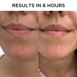 Tribe Skincare Anti-Inflammatory Pimple Patches 12 Tribe Skincare Anti-Inflammatory Pimple Patches -Hair Care Store Anti Inflammatory Pimple Patches Results 01