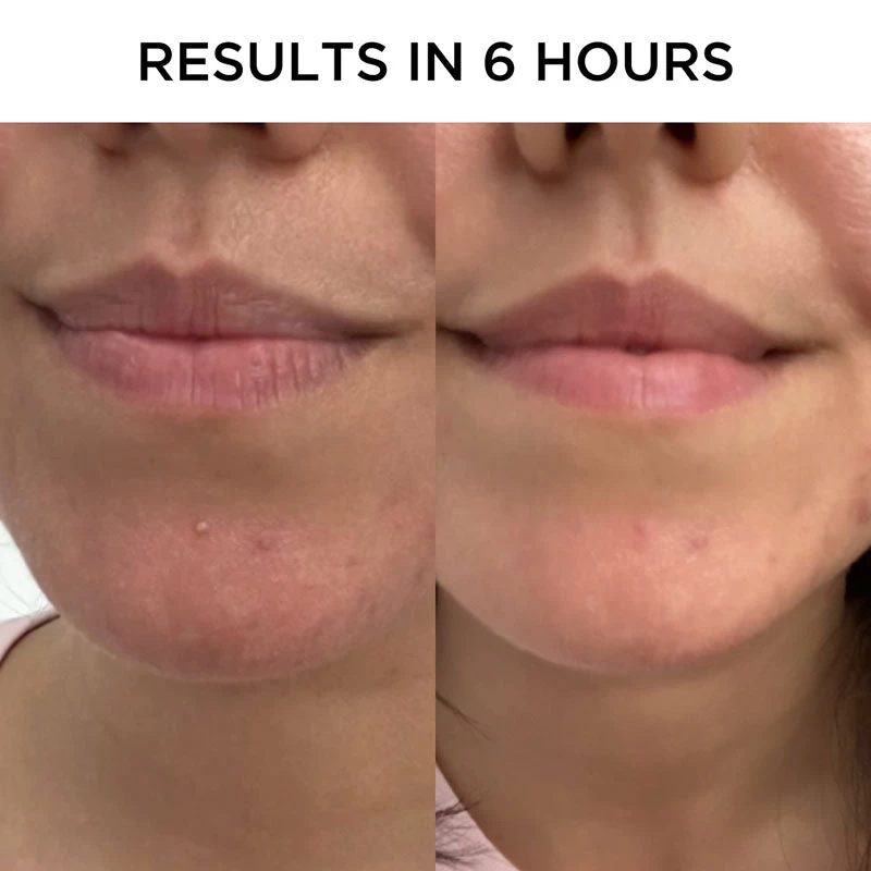 Tribe Skincare Anti-Inflammatory Pimple Patches 5 Tribe Skincare Anti-Inflammatory Pimple Patches - Image 5