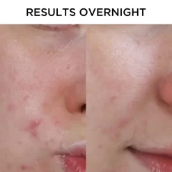 Tribe Skincare Anti-Inflammatory Pimple Patches 13 Tribe Skincare Anti-Inflammatory Pimple Patches -Hair Care Store Anti Inflammatory Pimple Patches Results 02