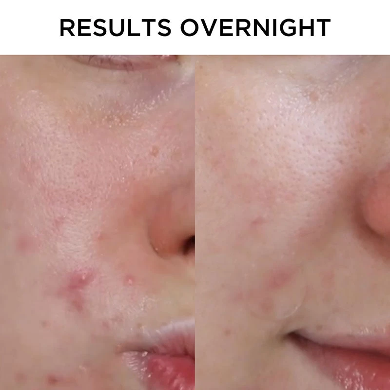 Tribe Skincare Anti-Inflammatory Pimple Patches 6 Tribe Skincare Anti-Inflammatory Pimple Patches - Image 6