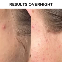 Tribe Skincare Anti-Inflammatory Pimple Patches 14 Tribe Skincare Anti-Inflammatory Pimple Patches -Hair Care Store Anti Inflammatory Pimple Patches Results 03